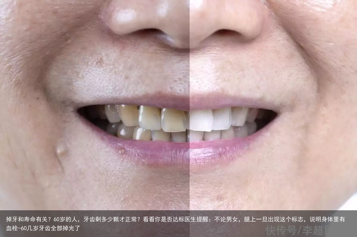 掉牙和寿命有关?60岁的人,牙齿剩多少颗才正常?看看你是否达标医生提醒:不论男女,腿上一旦出现这个标志,说明身体里有血栓-60几岁牙齿全部掉光了