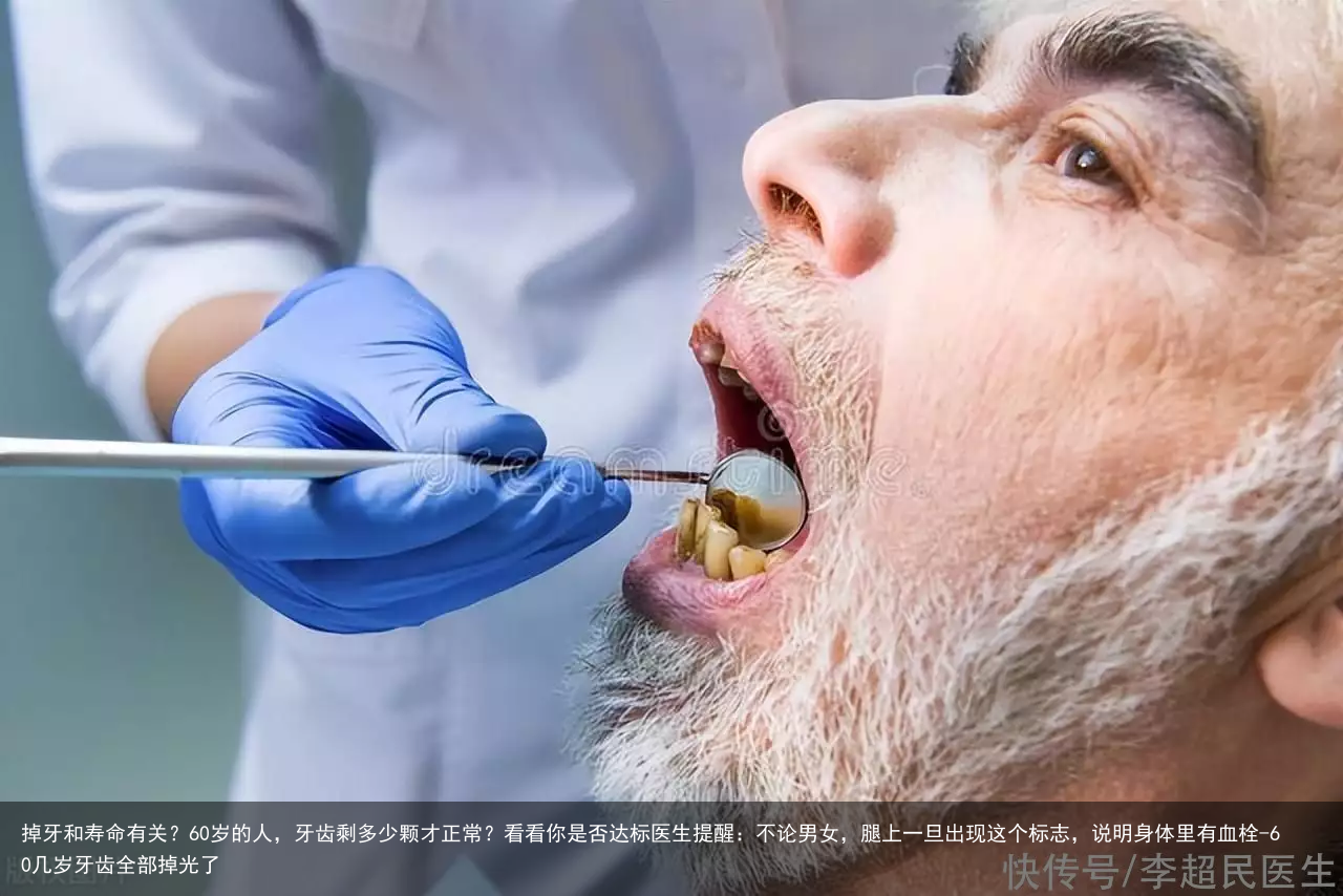掉牙和寿命有关?60岁的人,牙齿剩多少颗才正常?看看你是否达标医生提醒:不论男女,腿上一旦出现这个标志,说明身体里有血栓-60几岁牙齿全部掉光了