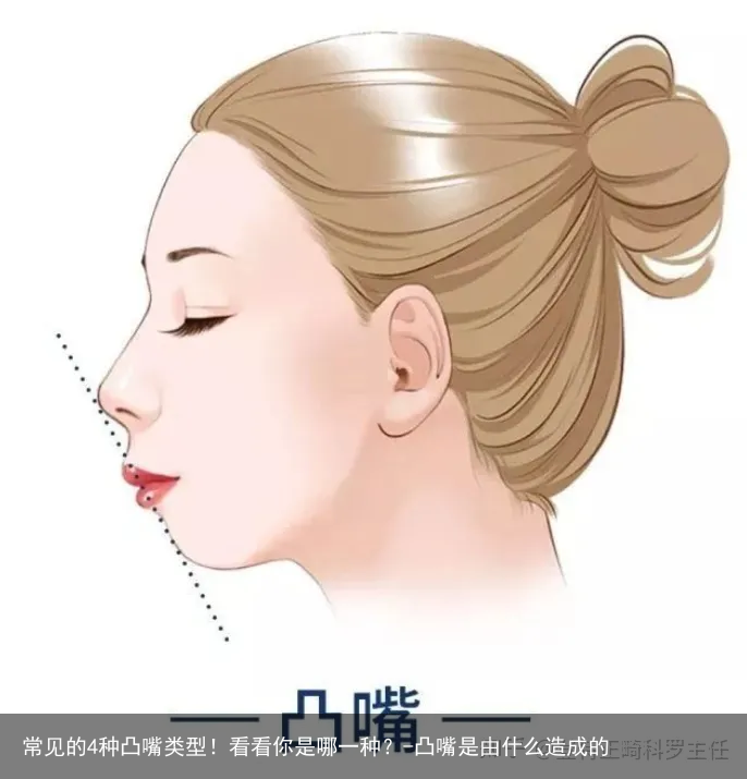 常见的4种凸嘴类型!看看你是哪一种?-凸嘴是由什么造成的