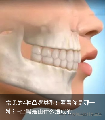 常见的4种凸嘴类型!看看你是哪一种?-凸嘴是由什么造成的