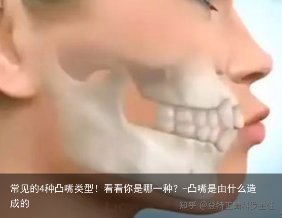 常见的4种凸嘴类型!看看你是哪一种?-凸嘴是由什么造成的