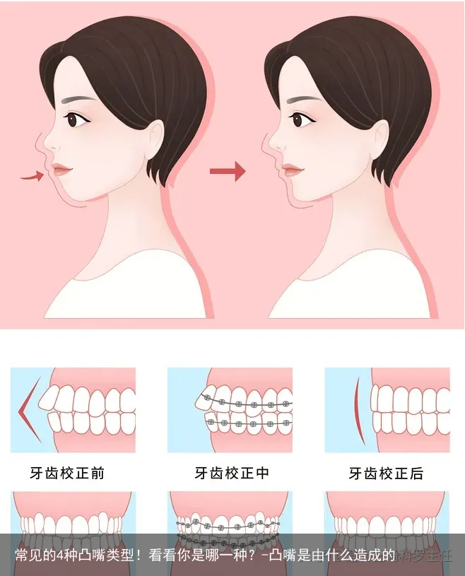 常见的4种凸嘴类型!看看你是哪一种?-凸嘴是由什么造成的