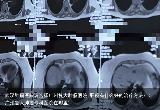 武汉肿瘤医院请选择广州复大肿瘤医院 肝癌有什么好的治疗方法?(广州复大肿瘤专科医院在哪里)