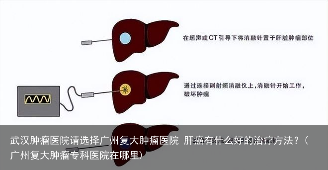 武汉肿瘤医院请选择广州复大肿瘤医院 肝癌有什么好的治疗方法?(广州复大肿瘤专科医院在哪里)