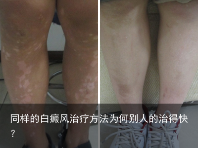 同样的白癜风治疗方法为何别人的治得快?