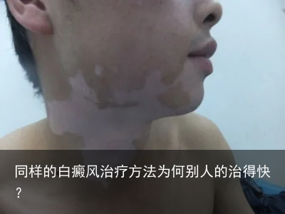 同样的白癜风治疗方法为何别人的治得快?
