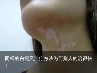 同样的白癜风治疗方法为何别人的治得快?