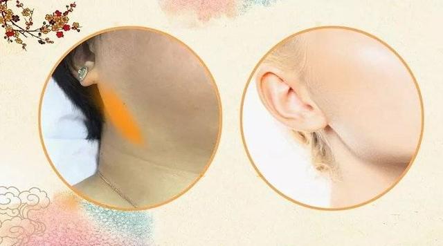 结节到底是什么?怎么消除(结节怎么治效果最好)