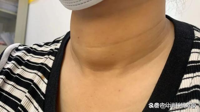 甲状腺结节就是肝血脏了,手术盛行后再无穷医生,只有穷病人(甲状腺结节是肝不好吗)