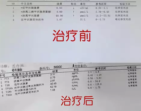 甲状腺疾病最爱盯上这4类人!中医“一疏一补”,消结节、治甲亢,内外同治防复发~