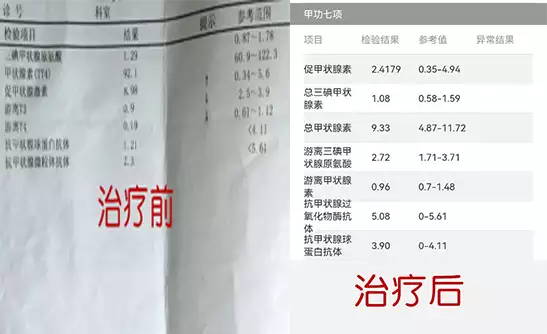 甲状腺疾病最爱盯上这4类人!中医“一疏一补”,消结节、治甲亢,内外同治防复发~