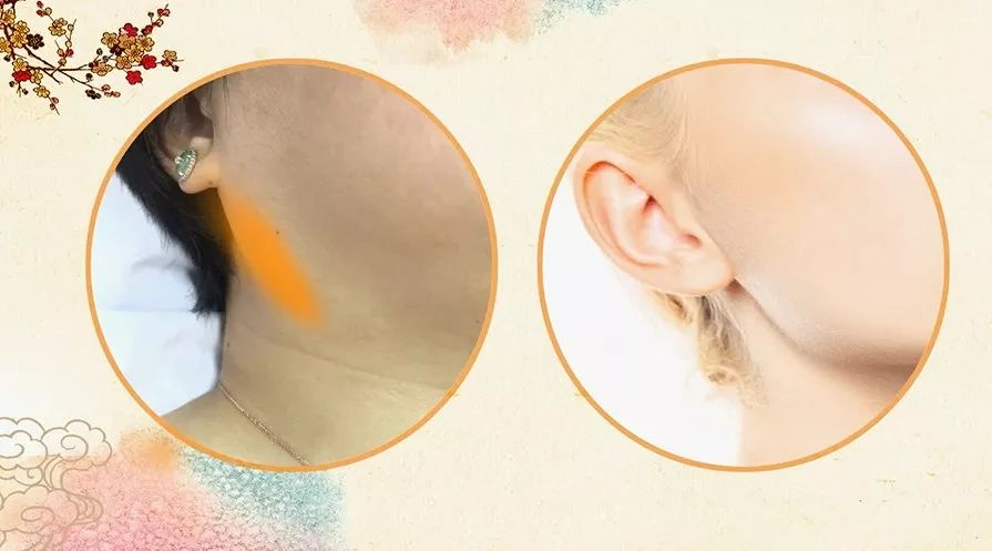 每个人身上都可能有“结节”!结节到底是什么?怎么消除?