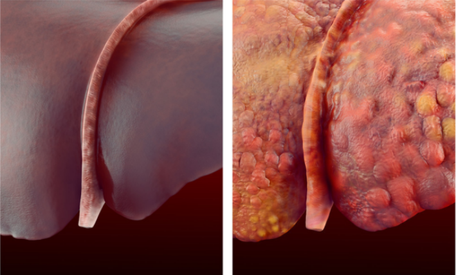 中医治疗结节更有优势,别让肝结节成为你的“劫”!