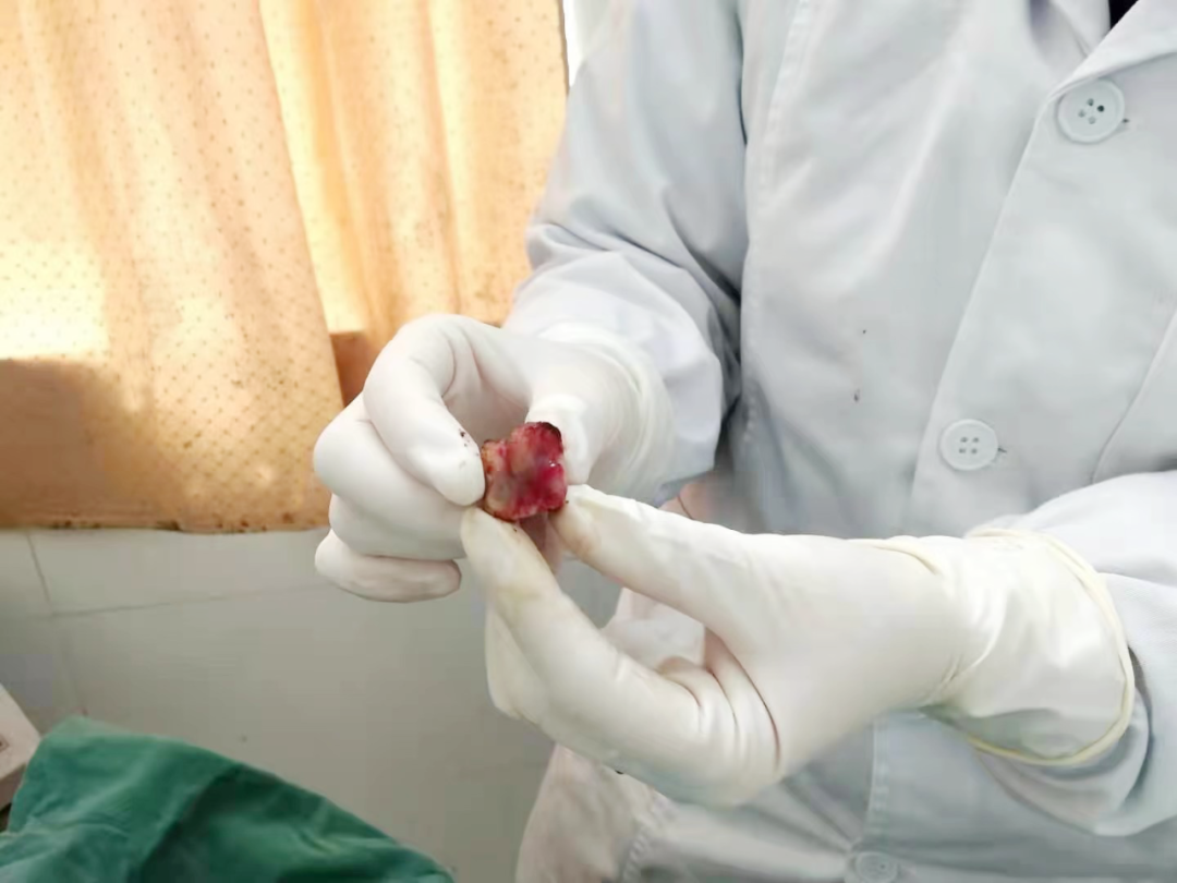 从高度鳞状上皮内病变走向癌症,宫颈锥切把她拦了下来-锥切高度鳞状上皮内病变累及腺体