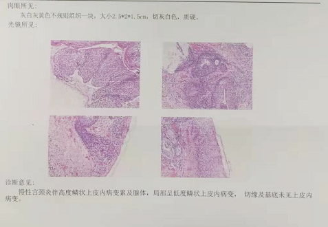 从高度鳞状上皮内病变走向癌症,宫颈锥切把她拦了下来-锥切高度鳞状上皮内病变累及腺体