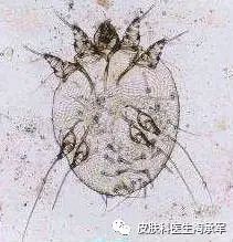 你知道疥疮是什么吗?-疥疮是什么引起的,什么症状