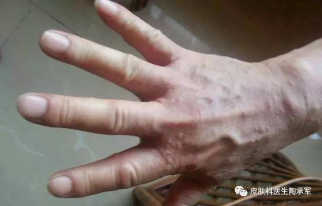 你知道疥疮是什么吗?-疥疮是什么引起的,什么症状