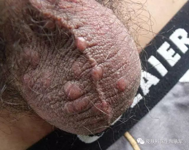 你知道疥疮是什么吗?-疥疮是什么引起的,什么症状