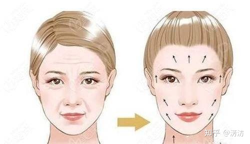 筋膜提升术是什么?闺蜜问:筋膜提升多少钱?-目前最安全的面部提升手术