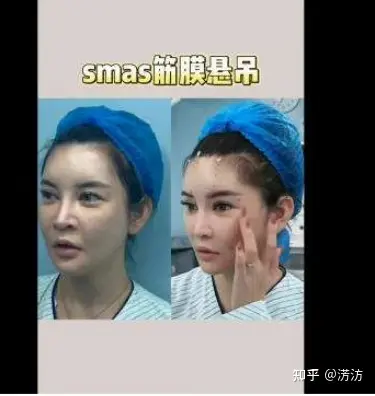 筋膜提升术是什么?闺蜜问:筋膜提升多少钱?-目前最安全的面部提升手术