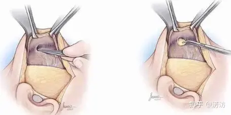 筋膜提升术是什么?闺蜜问:筋膜提升多少钱?-目前最安全的面部提升手术