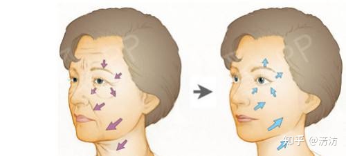 筋膜提升术是什么?闺蜜问:筋膜提升多少钱?-目前最安全的面部提升手术