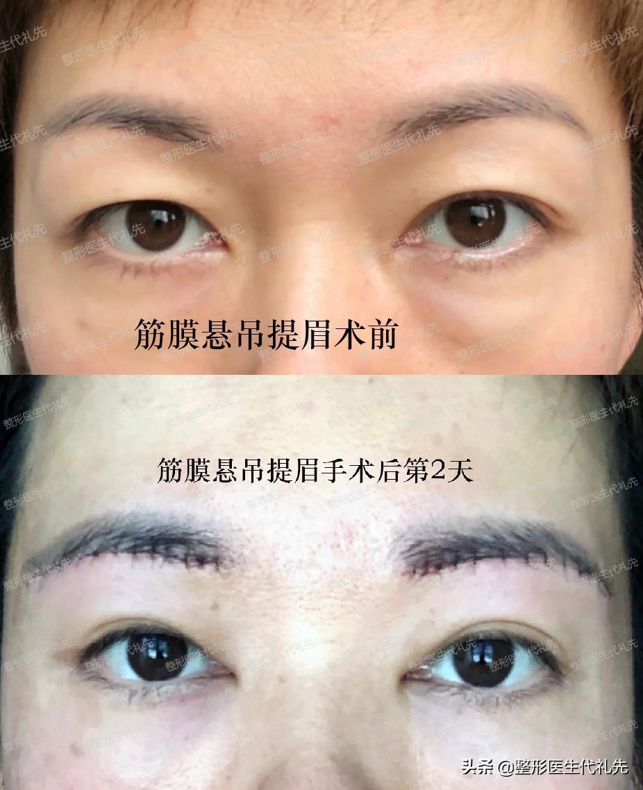 关于提眉手术总结了大家关心的18个问题,一起来看看-提眉术的优缺点