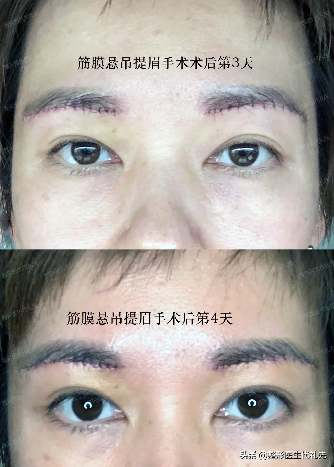 关于提眉手术总结了大家关心的18个问题,一起来看看-提眉术的优缺点