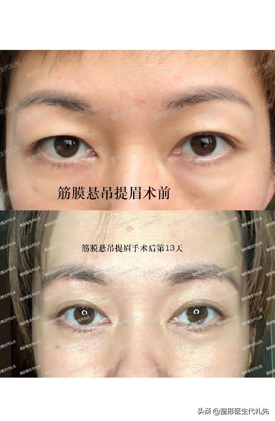 关于提眉手术总结了大家关心的18个问题,一起来看看-提眉术的优缺点