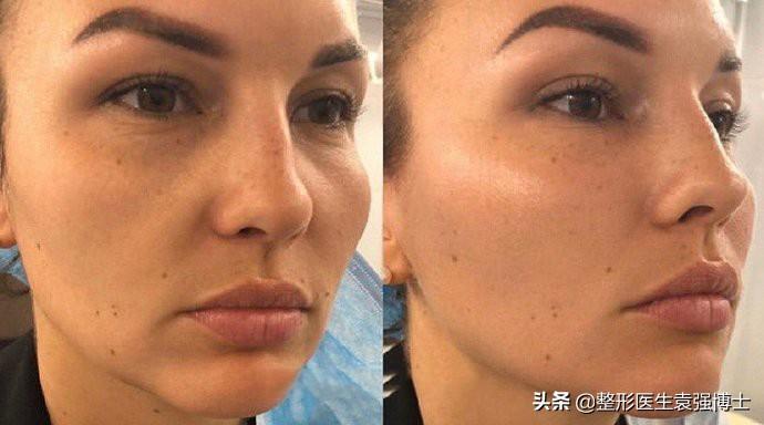 35岁后面部松弛,医生说这4种提升方式还不错-35岁下垂松弛的脸怎么办