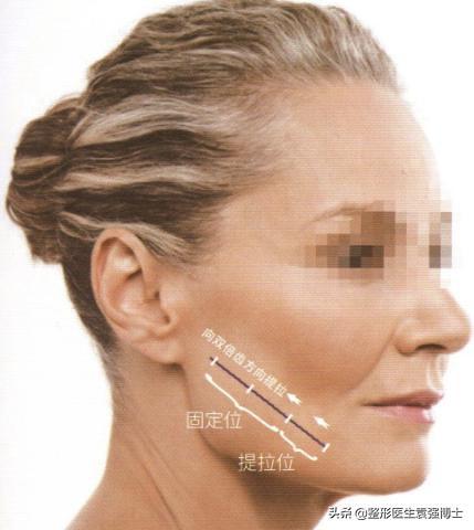 35岁后面部松弛,医生说这4种提升方式还不错-35岁下垂松弛的脸怎么办