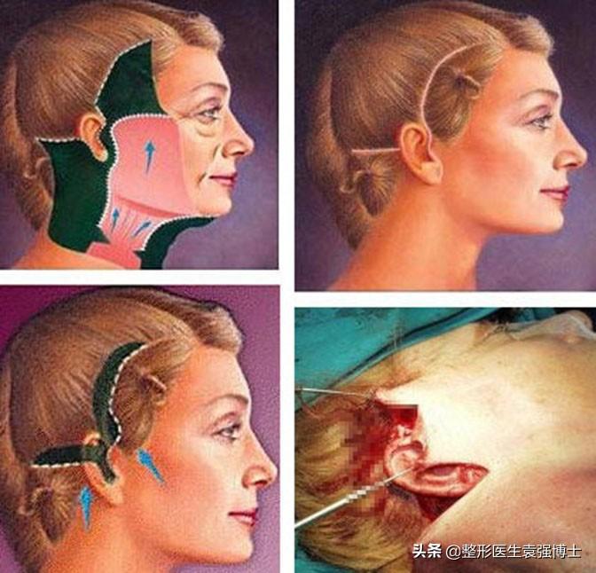 35岁后面部松弛,医生说这4种提升方式还不错-35岁下垂松弛的脸怎么办