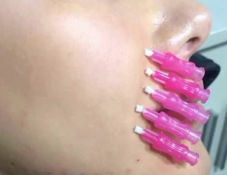 为什么有人做完筋膜提升后悔了,这些bug你有中吗?-筋膜提升有什么后遗症