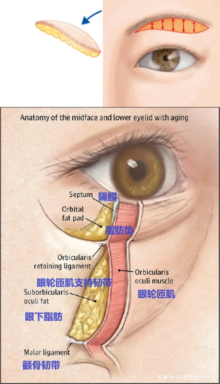 关于提眉去眼袋的大实话,医生来说几点真相,避免踩坑-提眉去眼袋注意事项