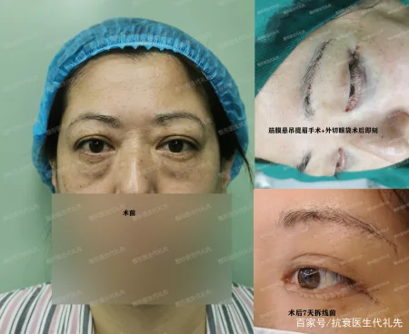 关于提眉去眼袋的大实话,医生来说几点真相,避免踩坑-提眉去眼袋注意事项