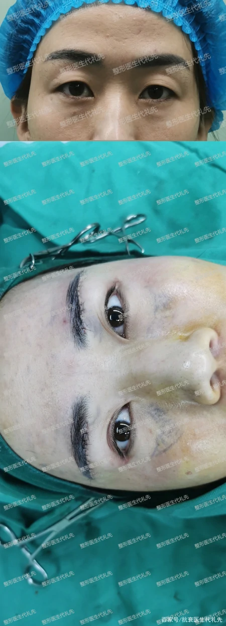 关于提眉去眼袋的大实话,医生来说几点真相,避免踩坑-提眉去眼袋注意事项