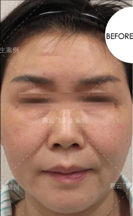 55岁做线雕没效果,来广州做拉皮手术,1周后像变了个人-线雕拉皮视频全过程播放