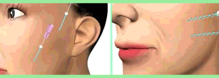 55岁做线雕没效果,来广州做拉皮手术,1周后像变了个人-线雕拉皮视频全过程播放