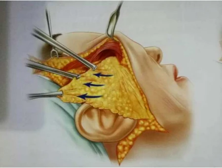 55岁做线雕没效果,来广州做拉皮手术,1周后像变了个人-线雕拉皮视频全过程播放