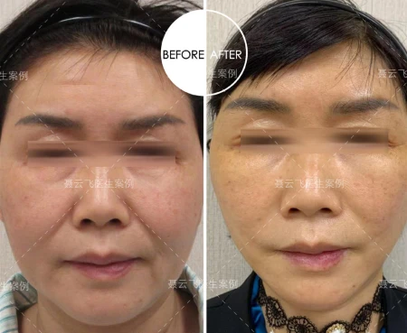 55岁做线雕没效果,来广州做拉皮手术,1周后像变了个人-线雕拉皮视频全过程播放