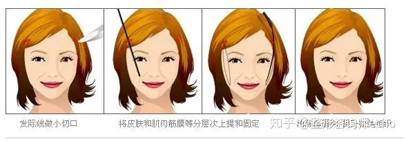 面部提升价格大概是多少?-面部提升怎么样