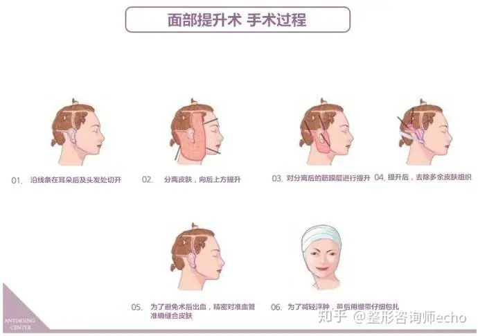 面部提升价格大概是多少?-面部提升怎么样