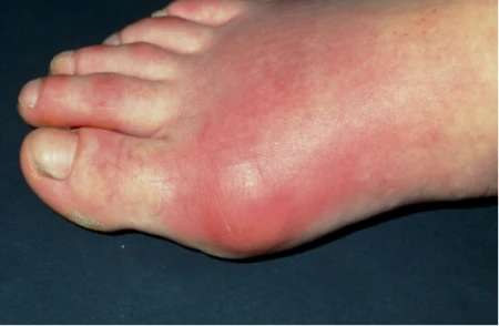 高尿酸的元凶找到了,远离这两样东西,尿酸变得稳定不高了-尿酸高避免哪些食物