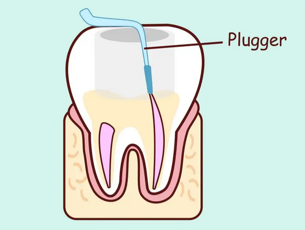 优诺口腔|牙膏可以补牙洞?别轻信......(用牙膏涂在蛀牙上可以缓解牙痛吗)