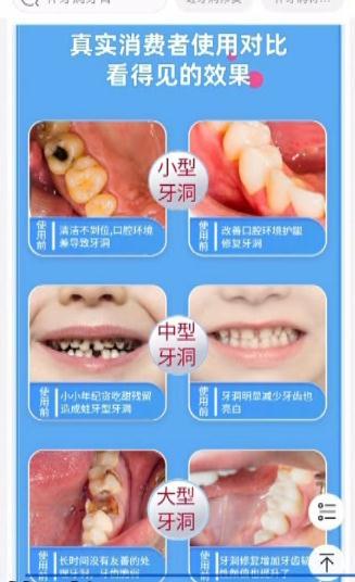 “功能性牙膏”热卖,10岁女孩为补牙却损失6颗牙(功能性牙膏的特点)