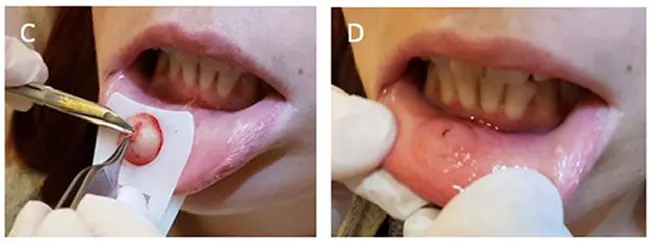 口腔溃疡怎么样才能好的更快?-口腔溃疡怎么能尽快好