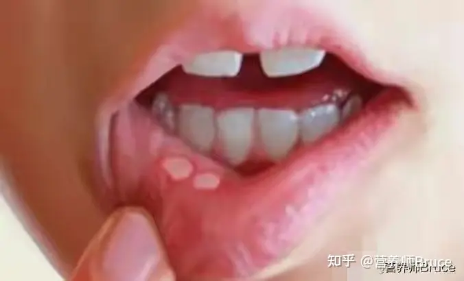 口腔溃疡有什么快速疗法?-口腔溃疡怎冶疗最好