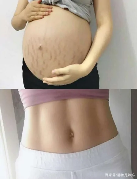 长了妊娠纹不能修复?错!用对方法,产后也能恢复“白净肚”-妊娠纹长了就不会消下去了吗