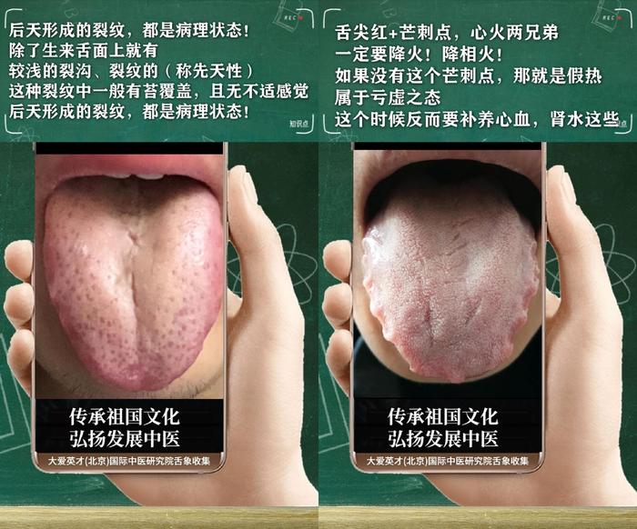 舌诊分析:生气、睡眠紊乱、水湿上泛、忽好忽坏很受影响-生气用中医学怎么说