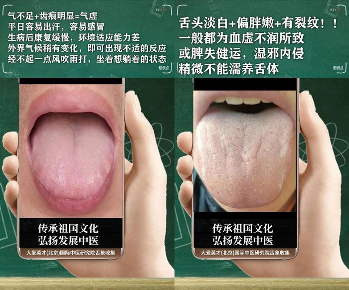 舌诊分析:生气、睡眠紊乱、水湿上泛、忽好忽坏很受影响-生气用中医学怎么说